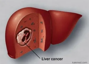 metastazele hepatice remedii populare Tratamentul