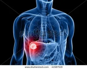 metastazele hepatice remedii populare Tratamentul