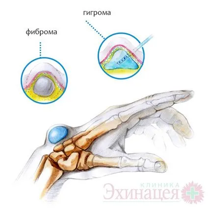 Tratamentul și îndepărtarea fibroamelor, mâini și picioare de tendon higroma ambulatoriu