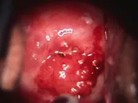 Leucoplakia de col uterin - ce este, cauze, simptome, diagnostic, tratament, fotografii