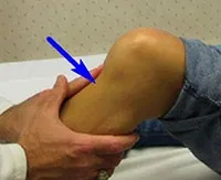 Ligamentoz лечение на коляното празнина кръстни връзки на