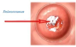 Leucoplakia de col uterin - ce este, cauze, simptome, diagnostic, tratament, fotografii