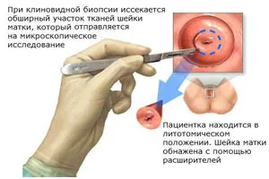 маточната шийка левкоплакия - какво е това, причини, симптоми, диагностика, лечение, снимки