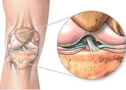 Ligamentoz лечение на коляното празнина кръстни връзки на