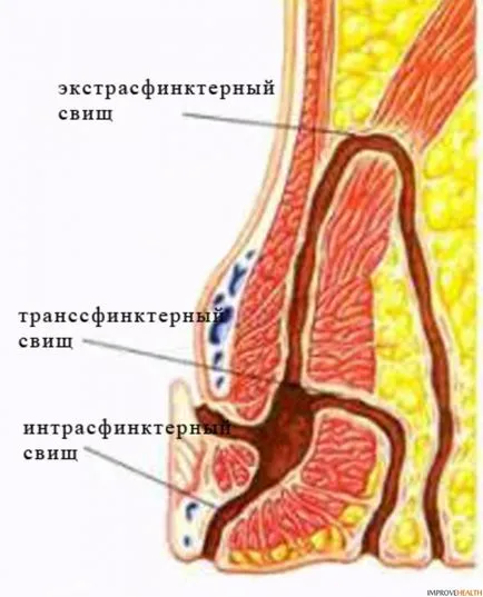 Лигатура фистула следоперативни лечение, хирургия UB, снимки