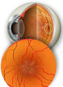 Macula - oftalmologie centru ophthalmica