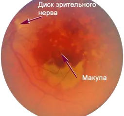 Eye macula okai és kezelése