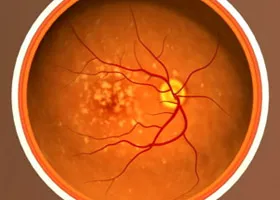 Macula - oftalmologie centru ophthalmica