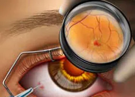 Macula - oftalmologie centru ophthalmica