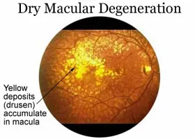 Macula - oftalmologie centru ophthalmica