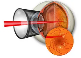 Macula - oftalmologie centru ophthalmica