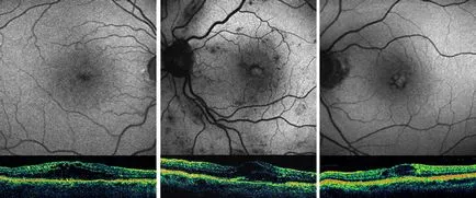 Macula - oftalmologie centru ophthalmica