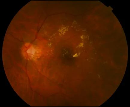 Macula - oftalmologie centru ophthalmica