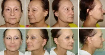 Mentoplasty брадичката пластична хирургия, корекция на