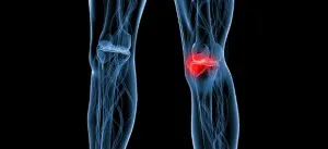Опори за коленете с остеоартрит на коляното как да си изберете, съвети