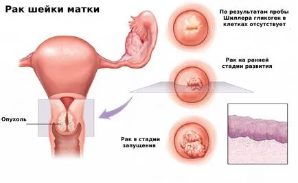 Възможно ли е да се види на ултразвук на рак на маточната шийка