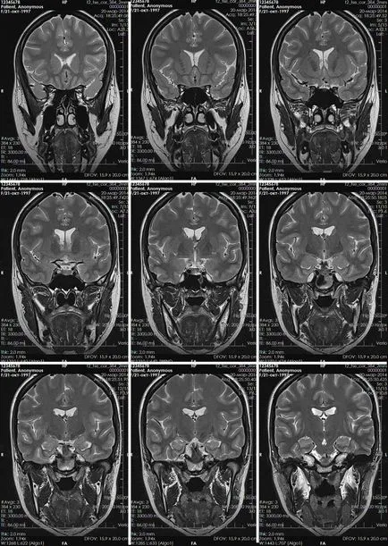 Brain MRI без разлика