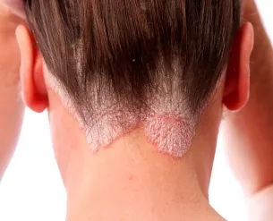 Tar a psoriasis