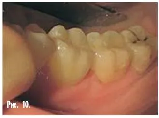 Dental-revue, articole, tehnologie ortopedice, fără metal, în stomatologie (m Sledkov