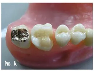 Dental-revue, articole, tehnologie ortopedice, fără metal, în stomatologie (m Sledkov