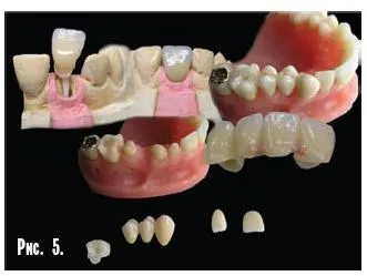 Dental-revue, articole, tehnologie ortopedice, fără metal, în stomatologie (m Sledkov