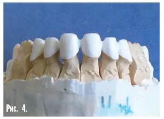 Dental-revue, articole, tehnologie ortopedice, fără metal, în stomatologie (m Sledkov