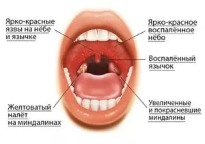 Облекчаване на болката за болки в гърлото при възрастни