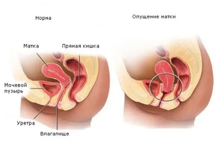 Пропускането на матката след раждане причини, последствия, лечение