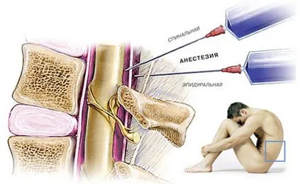 Diferențele de anestezie spinală și epidurală