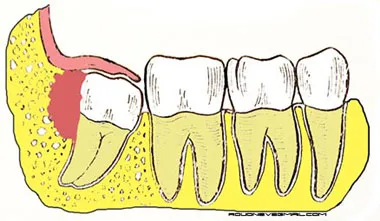 Перикоронити - каква е тази болест и как се лекува