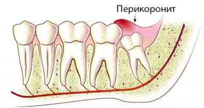 Pericoronitis imagine, tratament