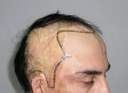 Пресаждането коса по главата практикуваните методи, цената на процедурата, преди и след снимки