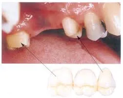 Érvek és ellenérvek a fogászati ​​implantátumok