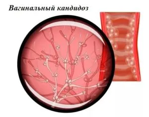 De ce se întoarce afte candidoza recurentă