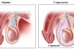 Ефекти след варикоцеле хирургия