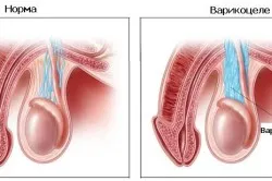 Ефекти след варикоцеле хирургия