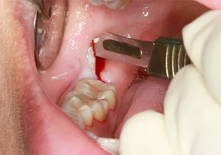 A kezelés után a fogak duzzadt arcát - okok és megoldások
