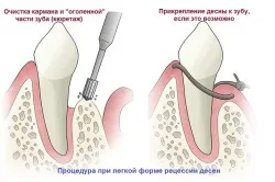 Венците преместени от лечение на зъба