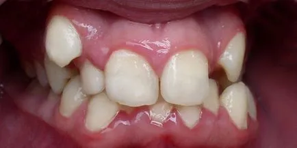 Dereglare și de retenție - anomalii dentitie