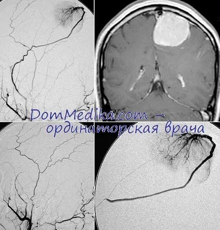 Differenciálása agydaganatok és a stroke