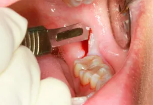 Eltávolítása után a fogat fragmentum a fogínyt, hogy mit kell csinálni, és mik a tünetek