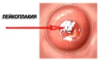 Причините и последствията от шийката на матката левкоплакия