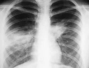Pneumonia Radical - simptome și tratament