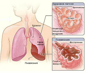 Pneumonia Radical - simptome și tratament