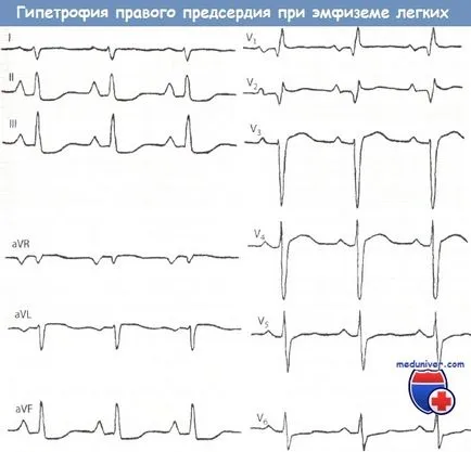 Jelek a jobb pitvari hipertrófia az EKG - Tüdő p