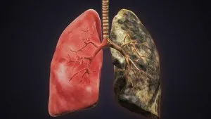 Cancerul pulmonar la caracteristicile terminale faza de afișare și proiecții