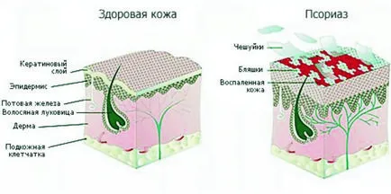 Псориазис лечение в домашни условия и процедури