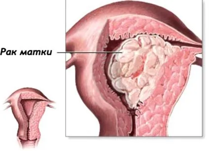 A rák a méhnyak és az endometrium az ultrahang