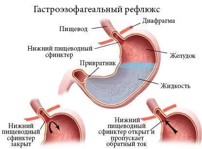 Отлив на стомашни болести