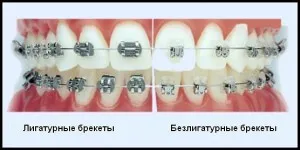 Самостоятелно лигиране скоби (bezligaturnye) снимки и за разлика от лигатура системи